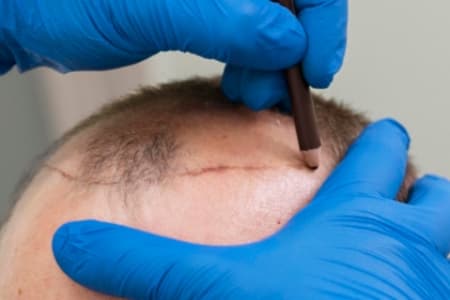 Micropigmentacin reconstructiva en Madrid
