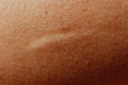 Micropigmentacin reconstructiva en Madrid